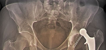 Orthopedic hip prostheses in Guadalajara