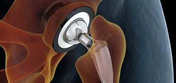 Orthopedics for Hip in Guadalajara