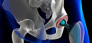 Orthopedics for Hip in Guadalajara