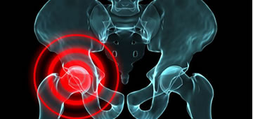 Orthopedics and hip prostheses in Guadalajara