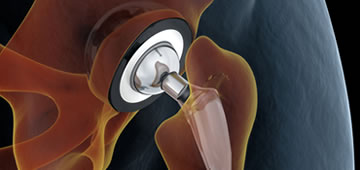 Orthopedics and hip prostheses in Guadalajara