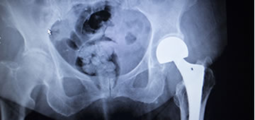 Orthopedics and hip prostheses in Guadalajara