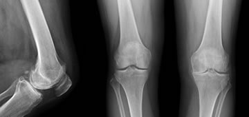 Ortopedia y prótesis de rodilla en Guadalajara Ortopedia y prótesis de rodilla en Guadalajara