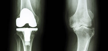 Ortopedia y prótesis de rodilla en Guadalajara Ortopedia y prótesis de rodilla en Guadalajara